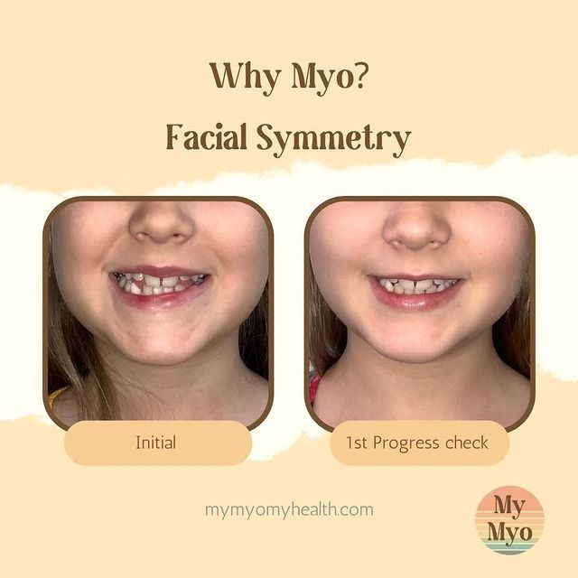 Facial Symmetry